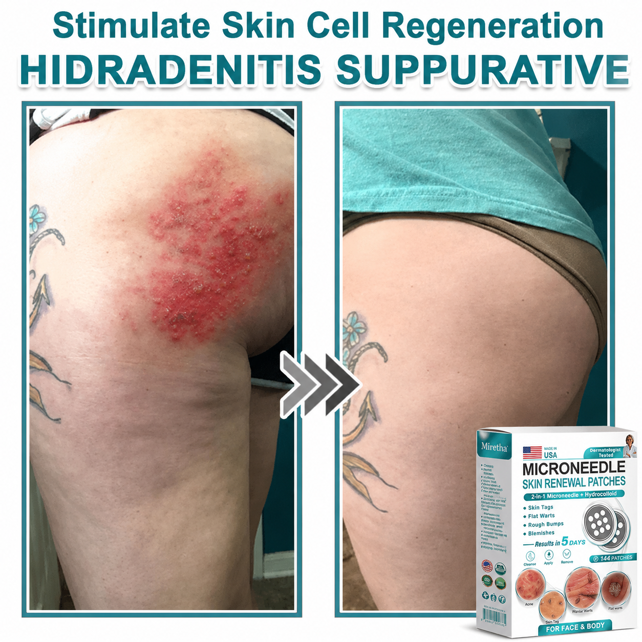 Miretha® 2-in-1 Microneedle & Hydrocolloid Patch👨‍⚕️ | Removes raised moles, acne, flat warts, and skin tags | Helps improve wrinkles, scars, and blemishes | Invisible patches for face and body💖