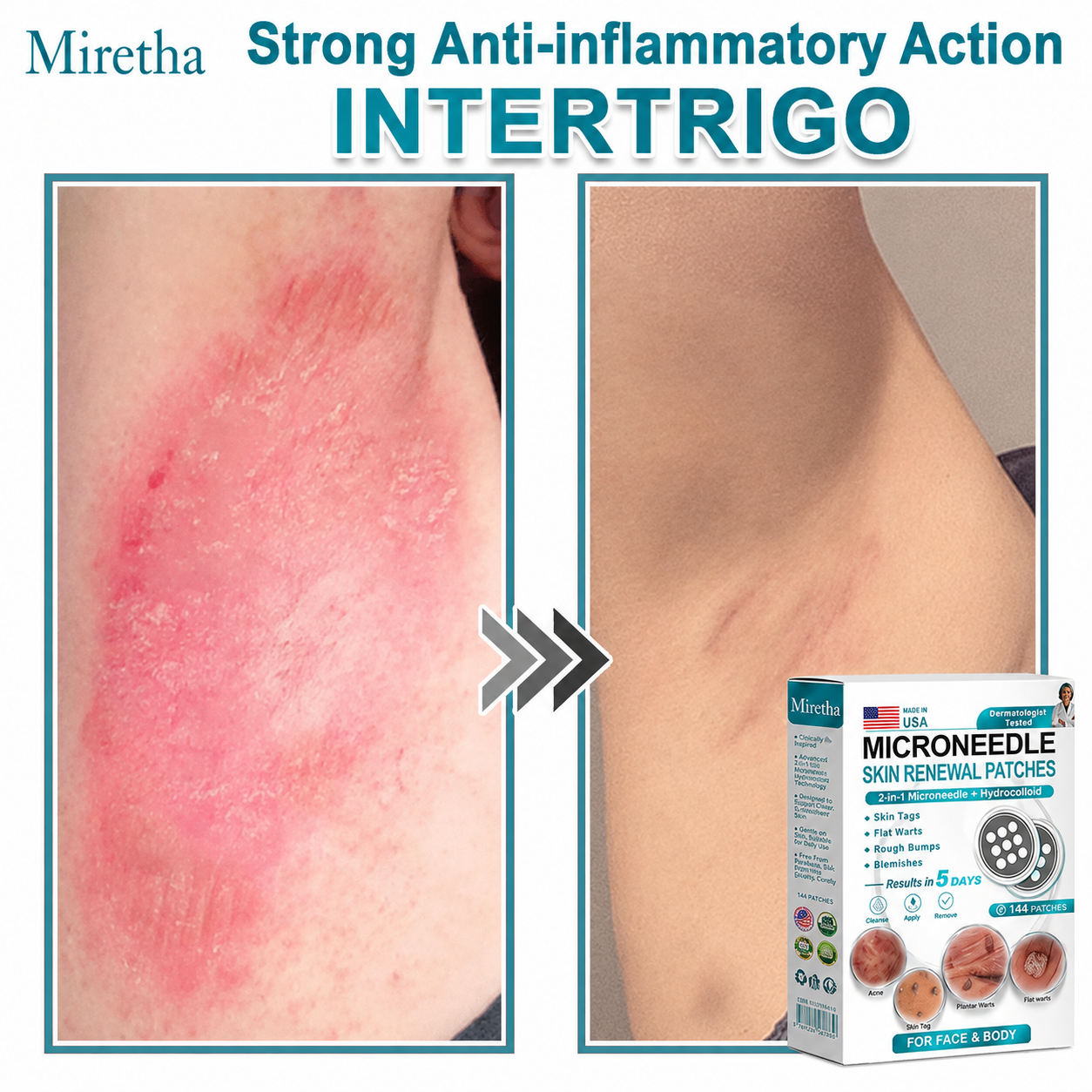 Miretha® 2-in-1 Microneedle & Hydrocolloid Patch👨‍⚕️ | Removes raised moles, acne, flat warts, and skin tags | Helps improve wrinkles, scars, and blemishes | Invisible patches for face and body💖
