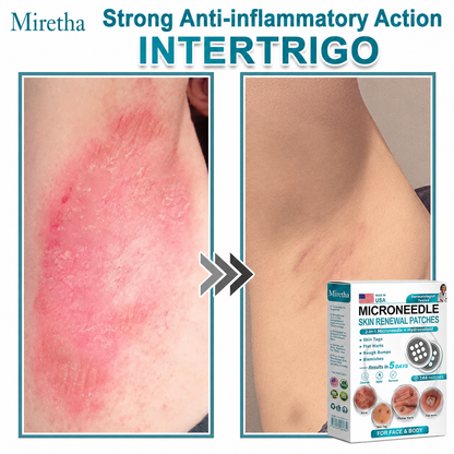 Miretha® 2-in-1 Microneedle & Hydrocolloid Patch👨‍⚕️ | Removes raised moles, acne, flat warts, and skin tags | Helps improve wrinkles, scars, and blemishes | Invisible patches for face and body💖