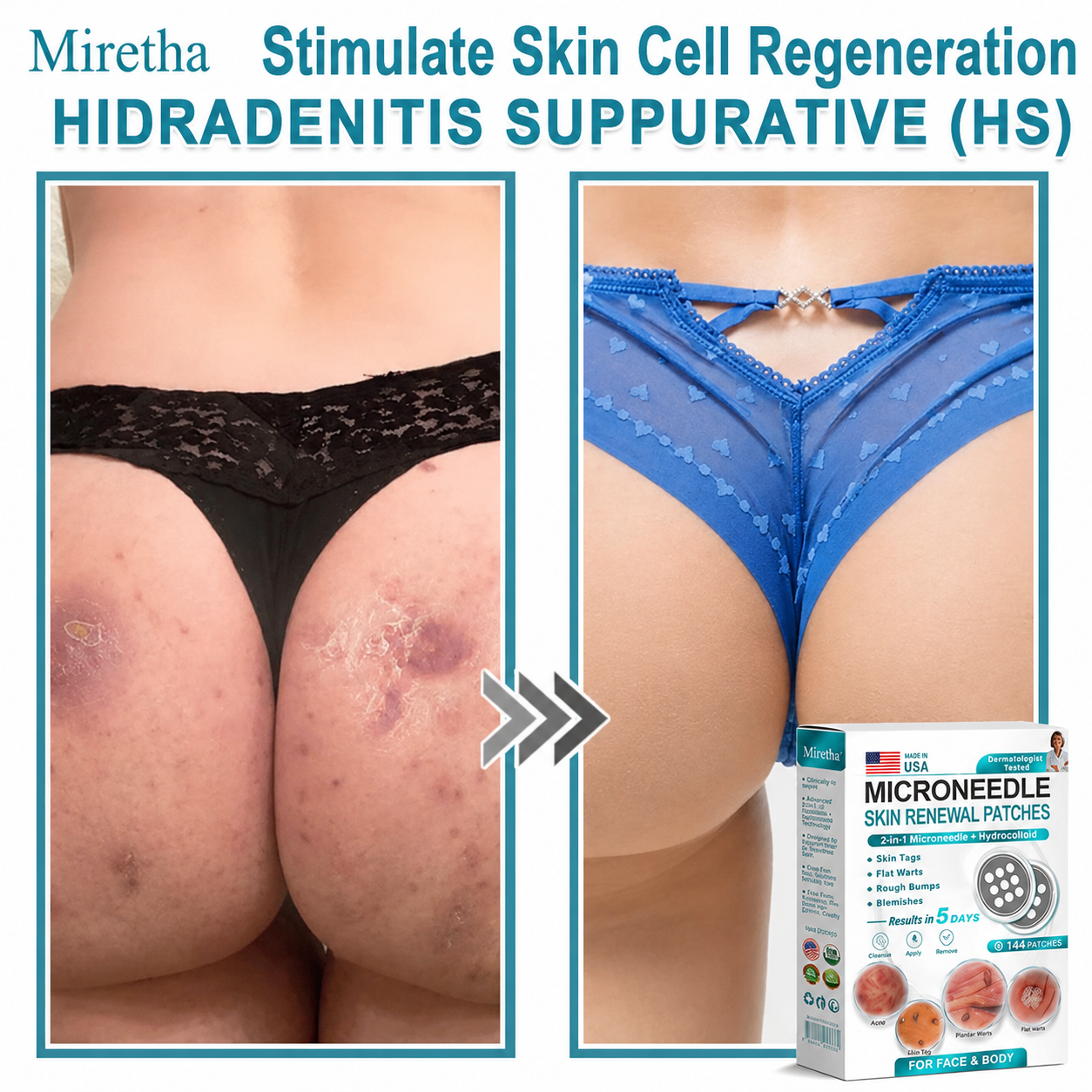 Miretha® 2-in-1 Microneedle & Hydrocolloid Patch👨‍⚕️ | Removes raised moles, acne, flat warts, and skin tags | Helps improve wrinkles, scars, and blemishes | Invisible patches for face and body💖