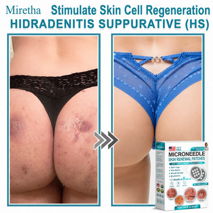 Miretha® 2-in-1 Microneedle & Hydrocolloid Patch👨‍⚕️ | Removes raised moles, acne, flat warts, and skin tags | Helps improve wrinkles, scars, and blemishes | Invisible patches for face and body💖
