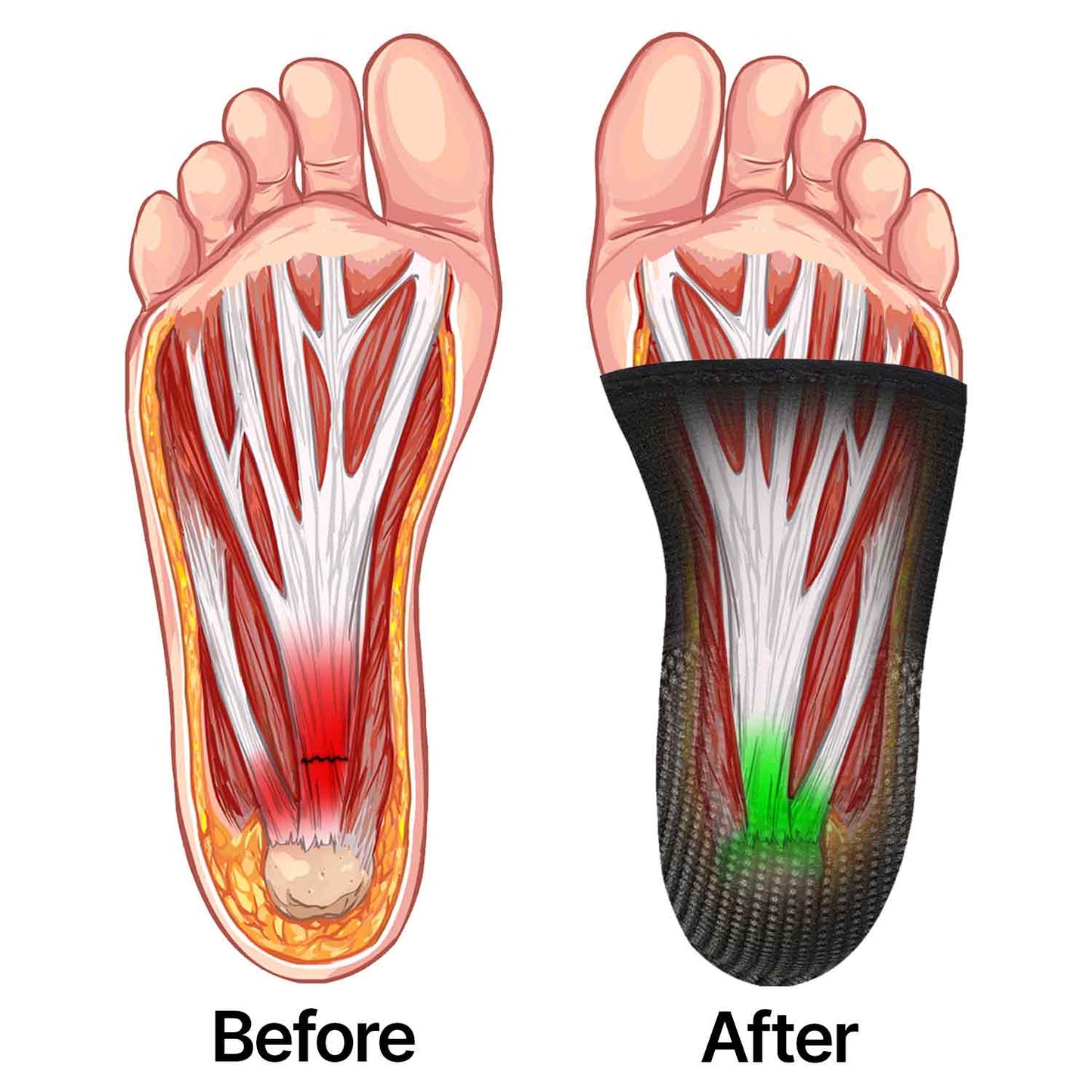 13 Reasons Why TopSpire Sleeves Actually Fix Morning Heel Pain (When Nothing Else Could)