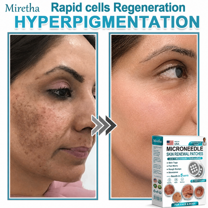 Miretha® 2-in-1 Microneedle & Hydrocolloid Patch👨‍⚕️ | Removes raised moles, acne, flat warts, and skin tags | Helps improve wrinkles, scars, and blemishes | Invisible patches for face and body💖