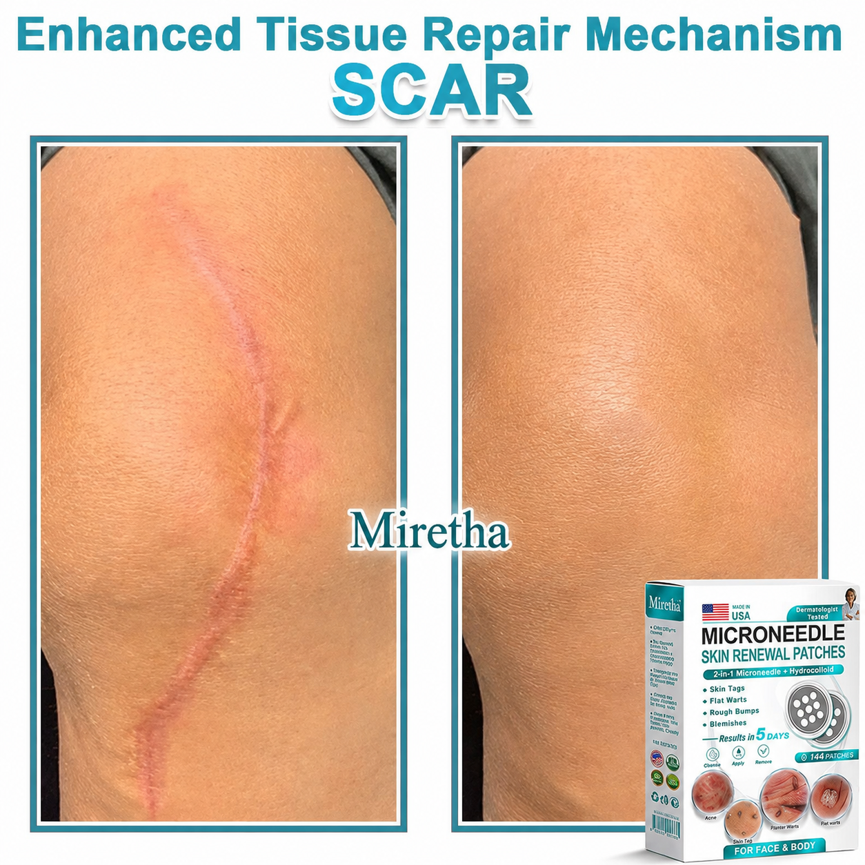 Miretha® 2-in-1 Microneedle & Hydrocolloid Patch👨‍⚕️ | Removes raised moles, acne, flat warts, and skin tags | Helps improve wrinkles, scars, and blemishes | Invisible patches for face and body💖