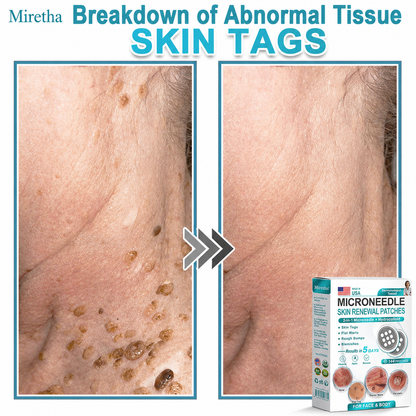 Miretha® 2-in-1 Microneedle & Hydrocolloid Patch👨‍⚕️ | Removes raised moles, acne, flat warts, and skin tags | Helps improve wrinkles, scars, and blemishes | Invisible patches for face and body💖