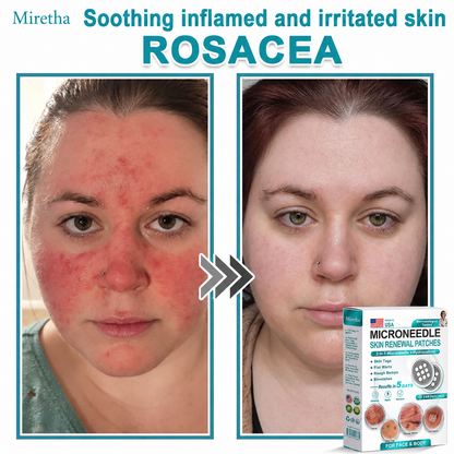 Miretha® 2-in-1 Microneedle & Hydrocolloid Patch👨‍⚕️ | Removes raised moles, acne, flat warts, and skin tags | Helps improve wrinkles, scars, and blemishes | Invisible patches for face and body💖