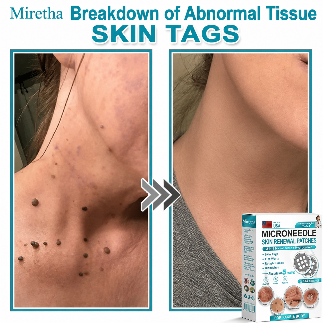Miretha® 2-in-1 Microneedle & Hydrocolloid Patch👨‍⚕️ | Removes raised moles, acne, flat warts, and skin tags | Helps improve wrinkles, scars, and blemishes | Invisible patches for face and body💖