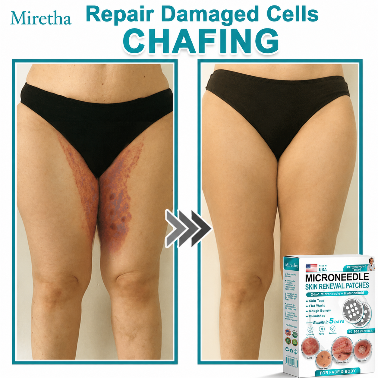 Miretha® 2-in-1 Microneedle & Hydrocolloid Patch👨‍⚕️ | Removes raised moles, acne, flat warts, and skin tags | Helps improve wrinkles, scars, and blemishes | Invisible patches for face and body💖
