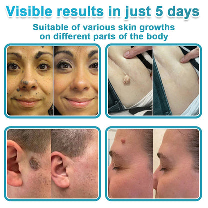 Miretha® 2-in-1 Microneedle & Hydrocolloid Patch👨‍⚕️ | Removes raised moles, acne, flat warts, and skin tags | Helps improve wrinkles, scars, and blemishes | Invisible patches for face and body💖