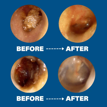 Miretha™ Earwax Removal Kit