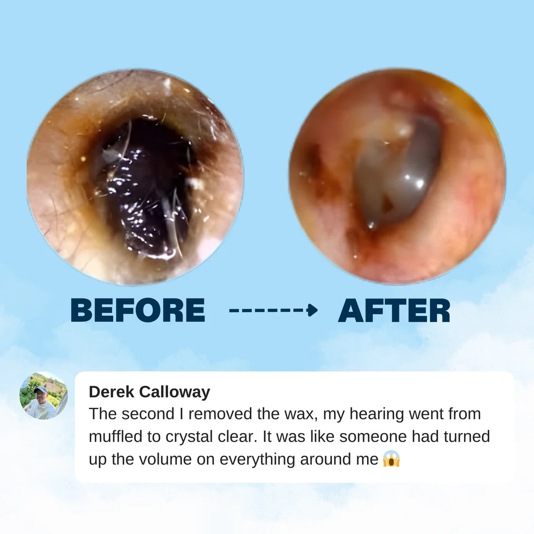 Miretha™ Earwax Removal Kit