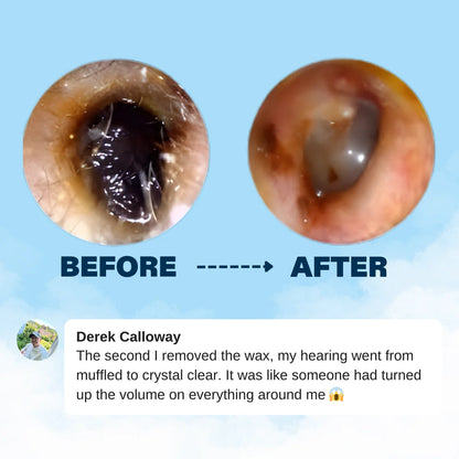 Miretha™ Earwax Removal Kit