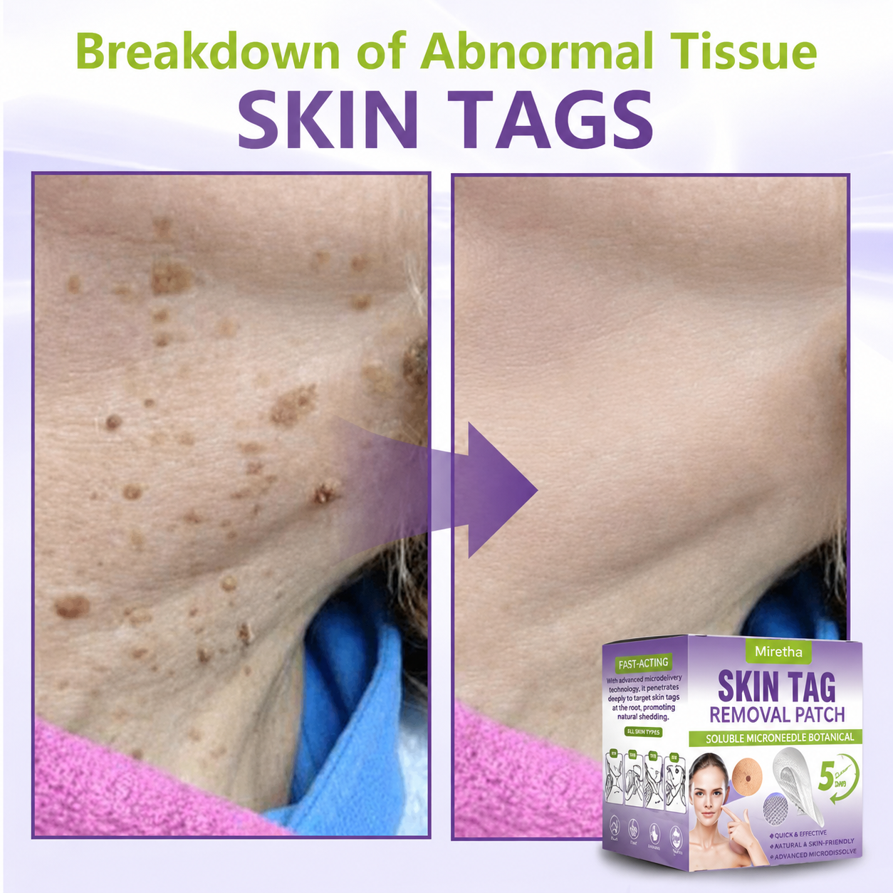 Miretha® Soluble Microneedle Botanical Skin Tag Removal Patch