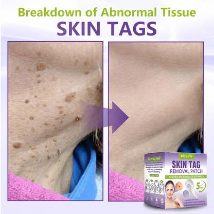 Miretha® Soluble Microneedle Botanical Skin Tag Removal Patch
