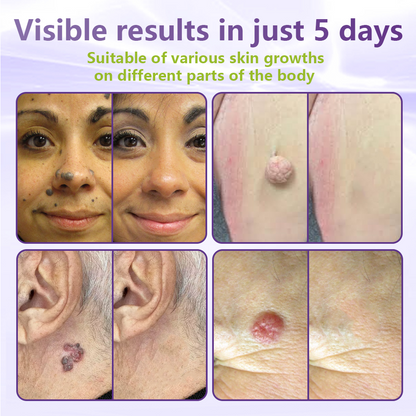 Miretha® Soluble Microneedle Botanical Skin Tag Removal Patch