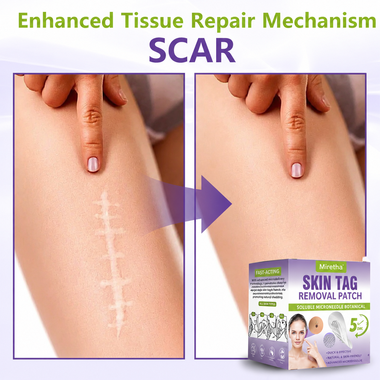 Miretha® Soluble Microneedle Botanical Skin Tag Removal Patch