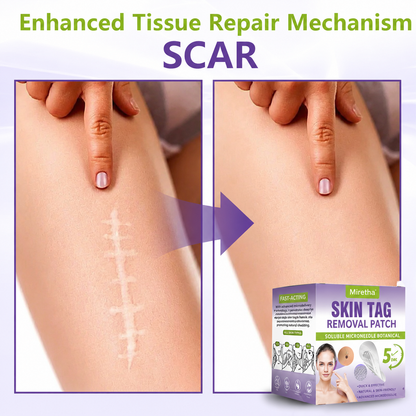 Miretha® Soluble Microneedle Botanical Skin Tag Removal Patch