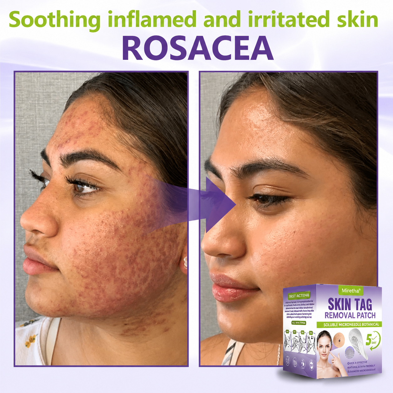 Miretha® Soluble Microneedle Botanical Skin Tag Removal Patch