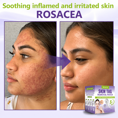 Miretha® Soluble Microneedle Botanical Skin Tag Removal Patch