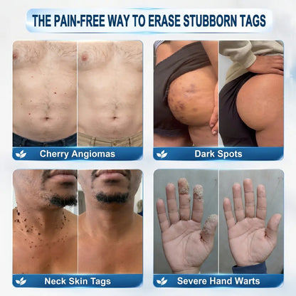 𝟕-𝐃𝒂𝘆 𝐒𝗸𝐢𝐧 𝐓𝒂𝗴 & 𝐒𝐩𝙤𝐭 𝐄𝐫𝒂𝐬𝙚𝐫 Painless & Scar-Free Advanced Imperfection Removal Rollerball Pen