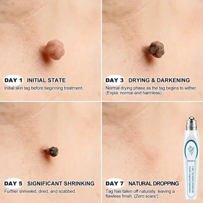 𝟕-𝐃𝒂𝘆 𝐒𝗸𝐢𝐧 𝐓𝒂𝗴 & 𝐒𝐩𝙤𝐭 𝐄𝐫𝒂𝐬𝙚𝐫 Painless & Scar-Free Advanced Imperfection Removal Rollerball Pen