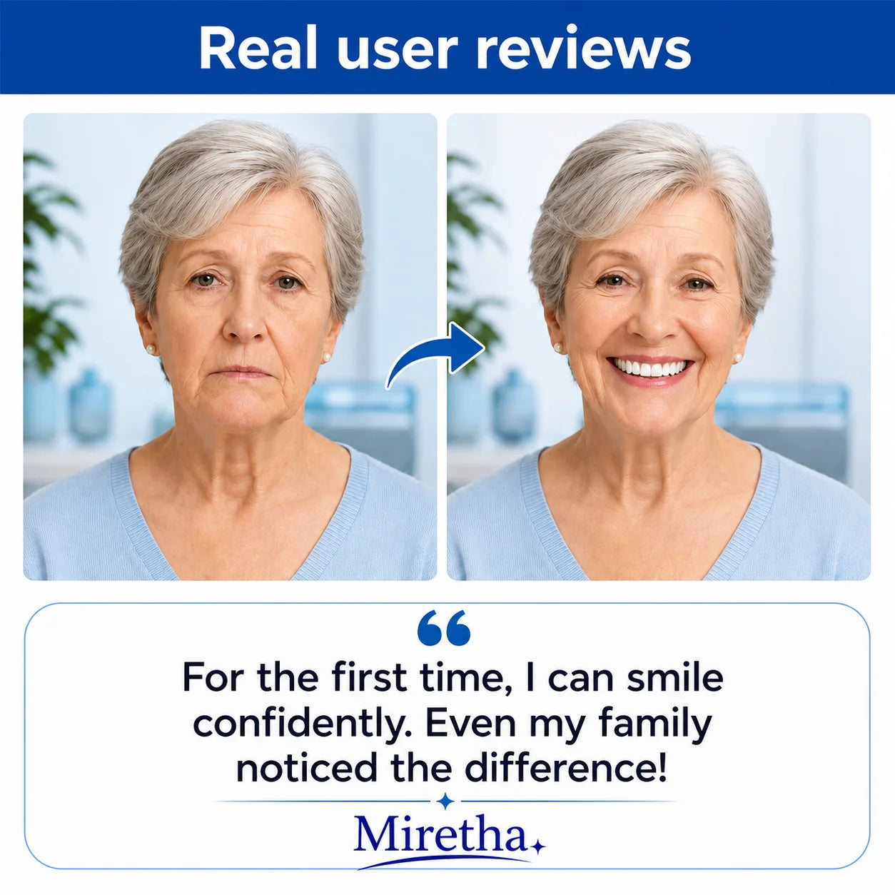 Custom-Fit Dentures for Everyday Comfort