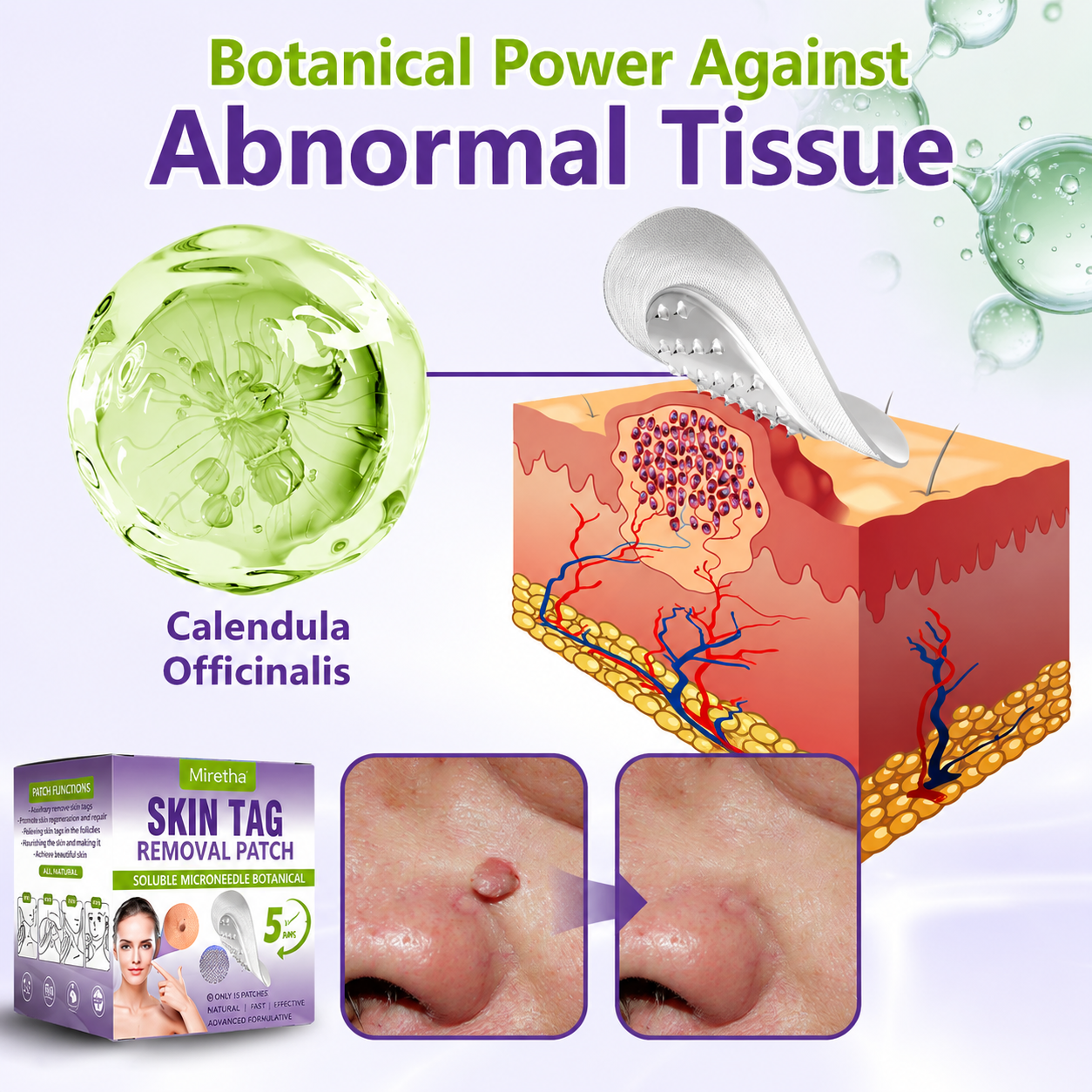 Miretha® Soluble Microneedle Botanical Skin Tag Removal Patch